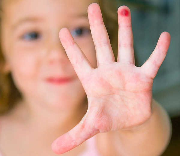 When Your Child Rips Their Hands On Gymnastics Bars...